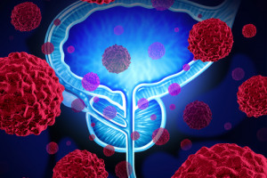 Jak provádět screening nosičů mutací BRCA na karcinom prostaty