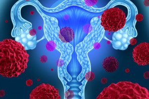 Cílená léčba ovariálního karcinomu