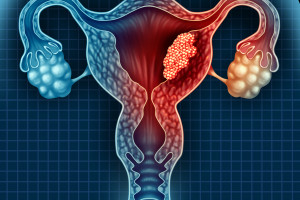 Pokročilý endometriální adenokarcinom a imunoterapie