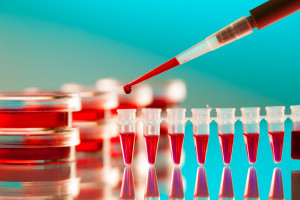 ESMO 2022 NEWS: Odhalování nádorů na základě krevních testů