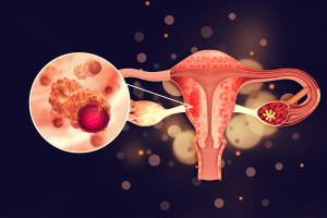 Jak mohou běžná analgetika ovlivnit přežití u rakoviny vaječníků?