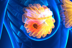 Časný karcinom prsu u starších pacientek - radioterapie ano či ne?