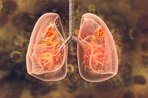 Nový test predikce konce života pacientů s rakovinou plic