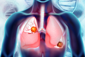 Přínos sekvenování nové generace v terapii nemalobuněčného plicního karcinomu – zaměřeno na rezistence u EGFR mutovaného nemalobuněčného plicního karcinomu