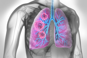 Tekutá biopsie predikuje odpověď na imunoterapii a toxicitu u pacientů s pokročilým karcinomem plic
