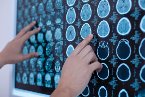 V BIOCEV začíná mezinárodní projekt na výzkum nádorů mozku