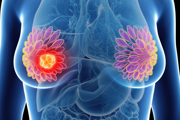 Karcinom prsu – personalizace a nové cílené terapie