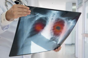 Novinky v léčbě karcinomu plic – výběr z přednášek ASCO